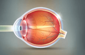 Exploring the Benefits of LASIK Beyond Visual Correction: Improved Quality of Life