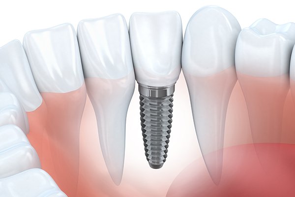 Dental Implants Explained: Benefits, Procedure, and Aftercare