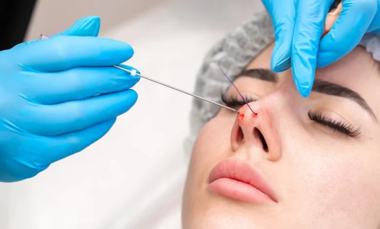 Nose Threadlift: Uncomplicated Way to Enhance Your Nose Without Surgery